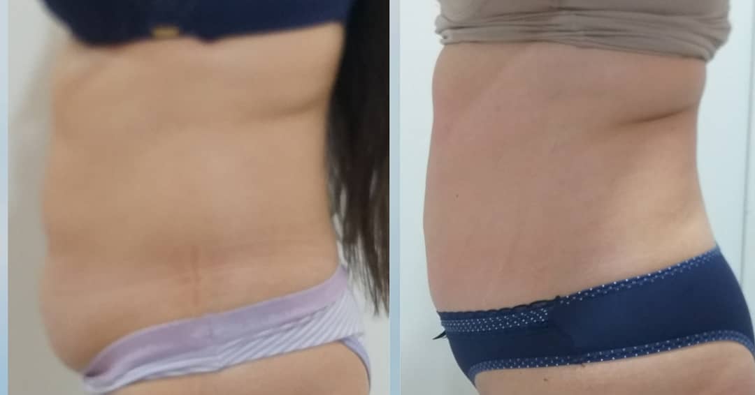 Evolução do tratamento de crio - Foto 7